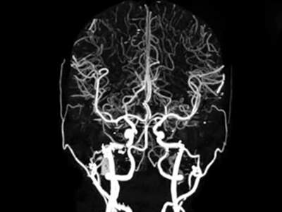 آنژیوگرافی مغز چیست و در چه مواردی نیاز است؟